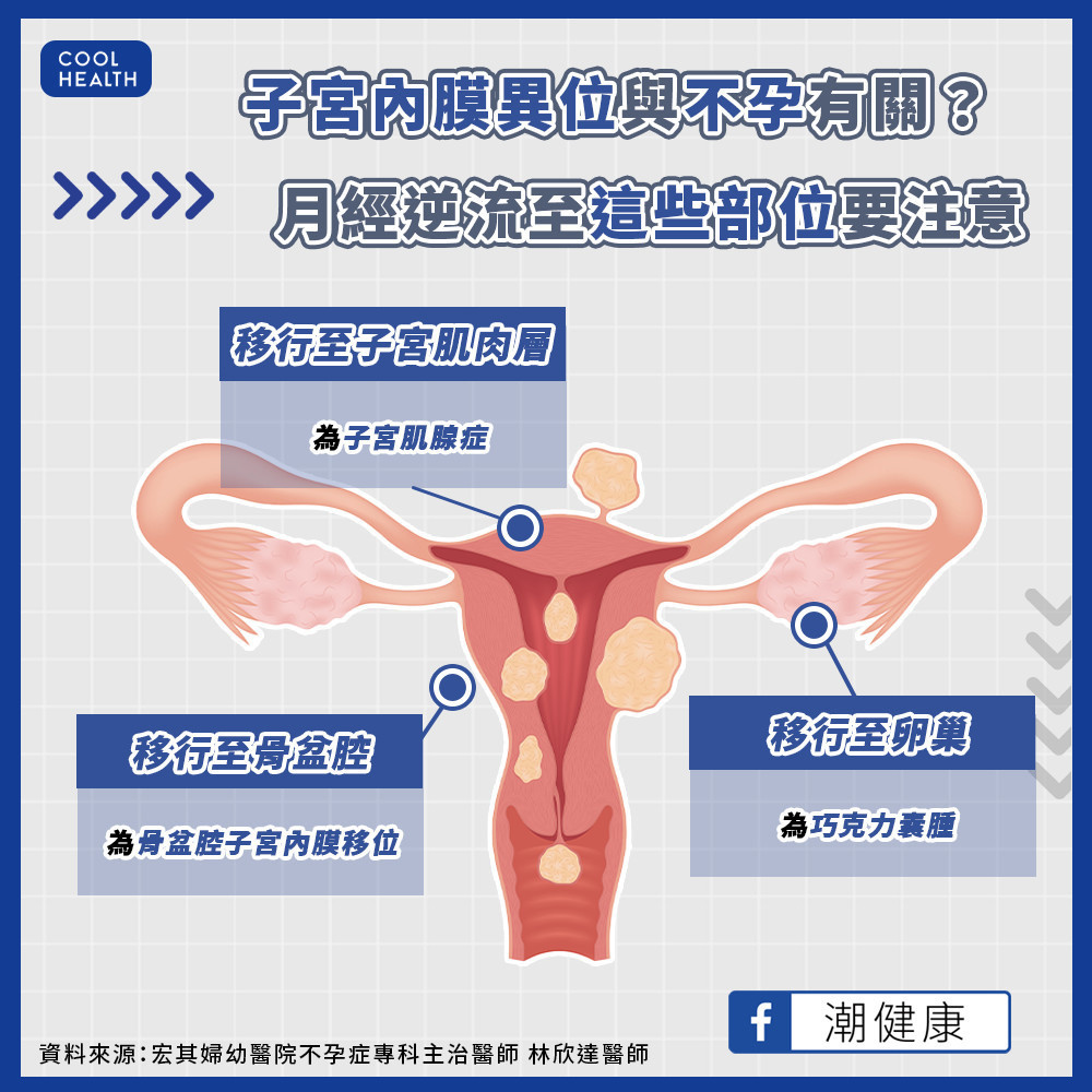孕氣差與「子宮內膜異位」有關？  患者占不孕症人口逾4成