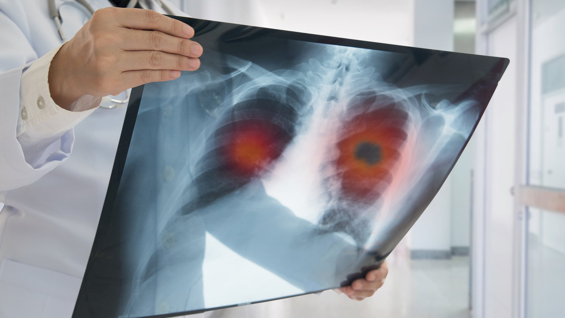 肺癌人數上升更「年輕化」？誰該做低劑量電腦斷層掃描？