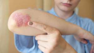乾癬共病問題遍全身  皮膚科醫學會最新指引：朝病灶「清零」目標邁進