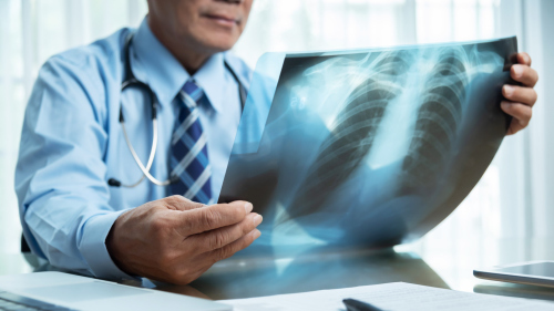肺癌提早發現？  AI能偵測肺結節？  國泰醫院3000例實測：準確度有望破9成